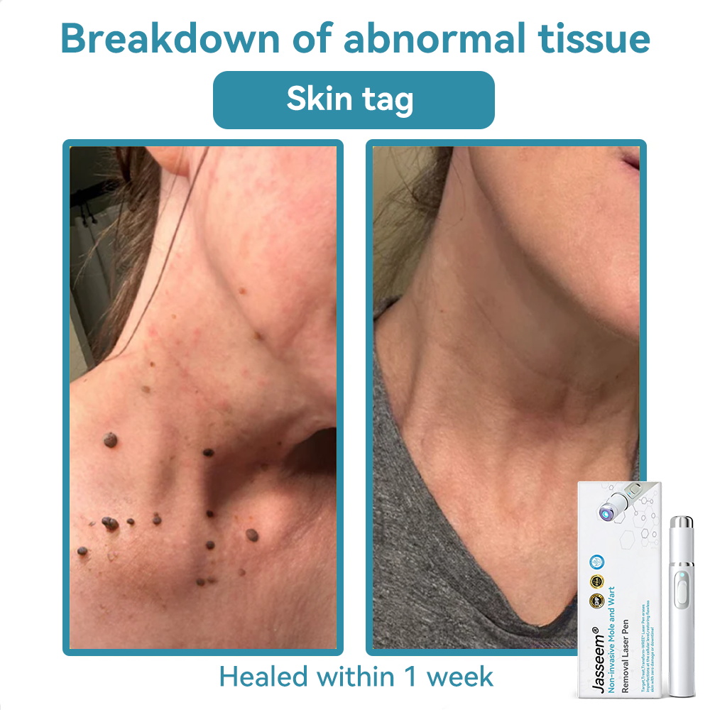๐๐๐ฌ๐ฌ๐๐๐ฆยฎ Medical-Grade Laser Pen ๐ (Powered by COโ laser technology โ effectively removes moles, warts, skin tags, pigmentation spots, and other skin imperfections)