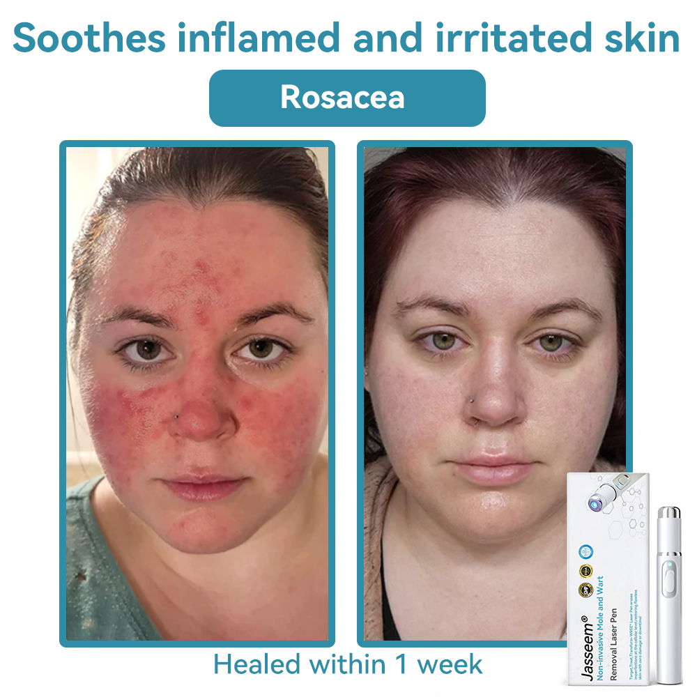 ๐๐๐ฌ๐ฌ๐๐๐ฆยฎ Medical-Grade Laser Pen ๐ (Powered by COโ laser technology โ effectively removes moles, warts, skin tags, pigmentation spots, and other skin imperfections)
