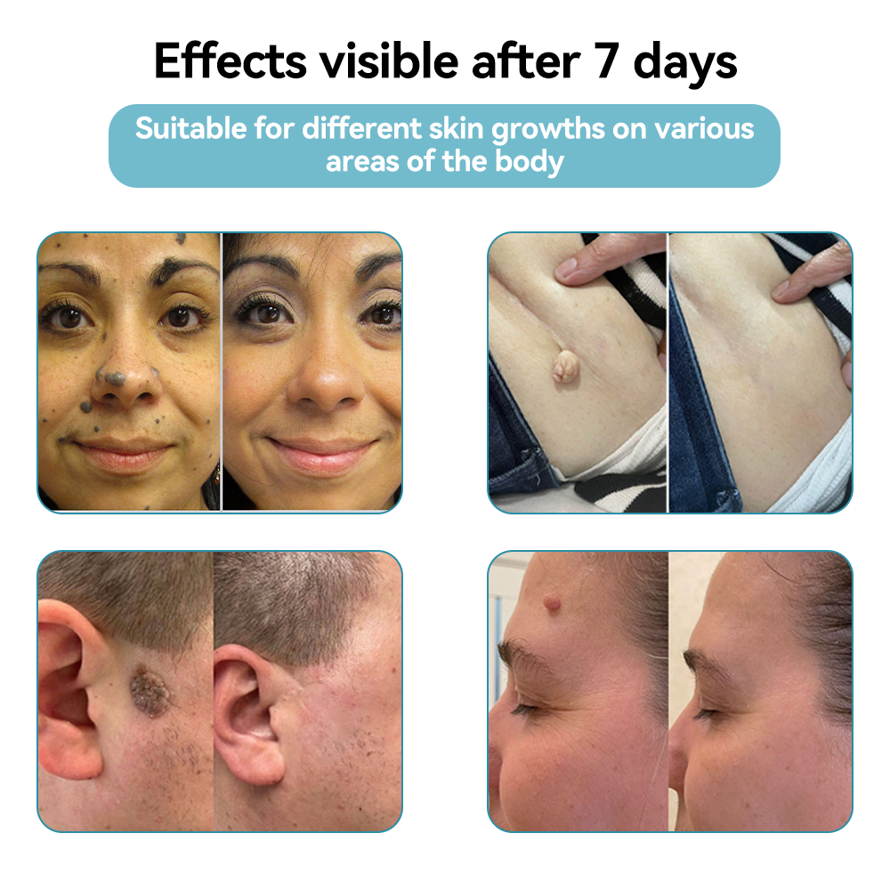 𝐉𝐚𝐬𝐬𝐞𝐞𝐦® Medical-Grade Laser Pen 🎉 (Powered by CO₂ laser technology – effectively removes moles, warts, skin tags, pigmentation spots, and other skin imperfections)